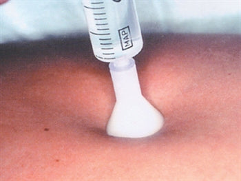 S.I.T. TERAPIA INIEZIONE CUTANEA 31G 0,26x2,5mm - bianco