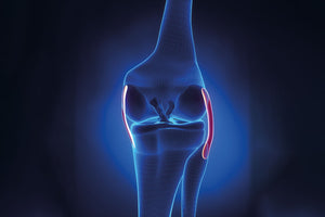 Distorsione di ginocchio senza rottura dei legamenti