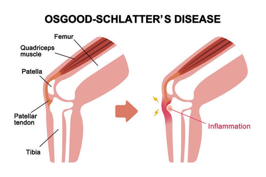 Morbo di Osgood-Schlatter