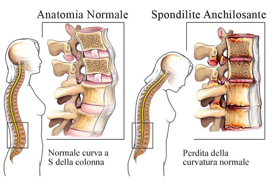 La spondilite anchilosante